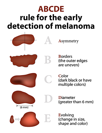 medical melanoma abcd