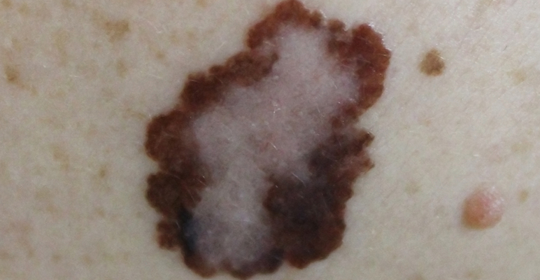 medical melanoma