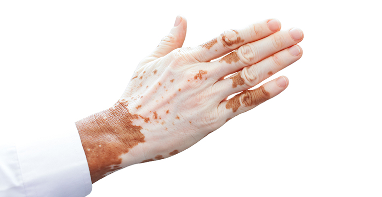 medical vitiligo