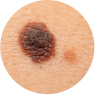 melanoma