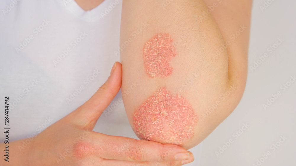 psoriasis