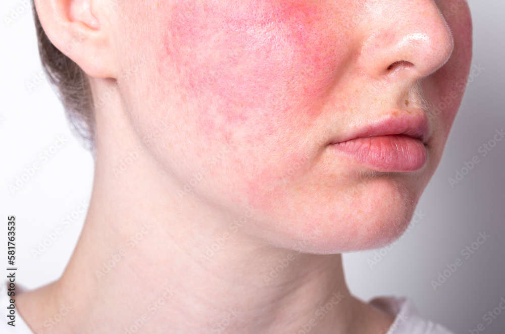 rosacea