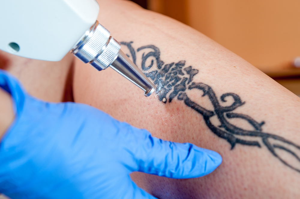 Laser Tattoo Removal | New Jersey | Skin & Laser Center of NJ