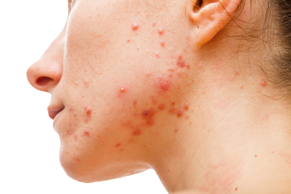 medical acne