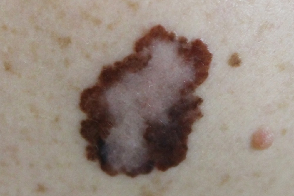 Medical Melanoma