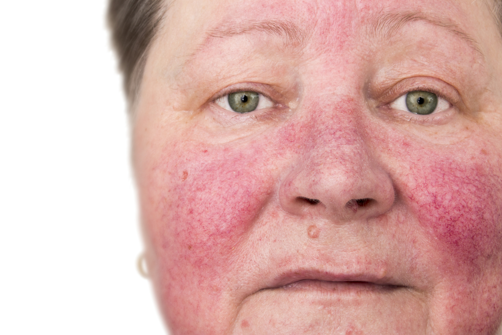 Medical Rosacea